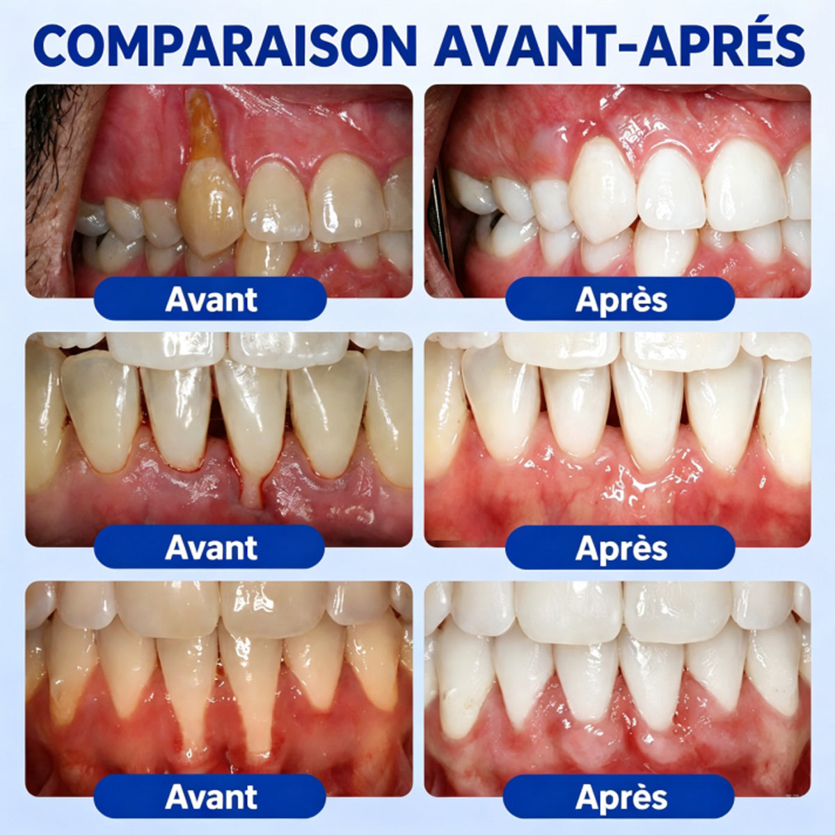 🇫🇷👨‍⚕️✅🦷 HEATWOLF® GumRevive – Gel réparateur parodontal 🦷✨1️⃣