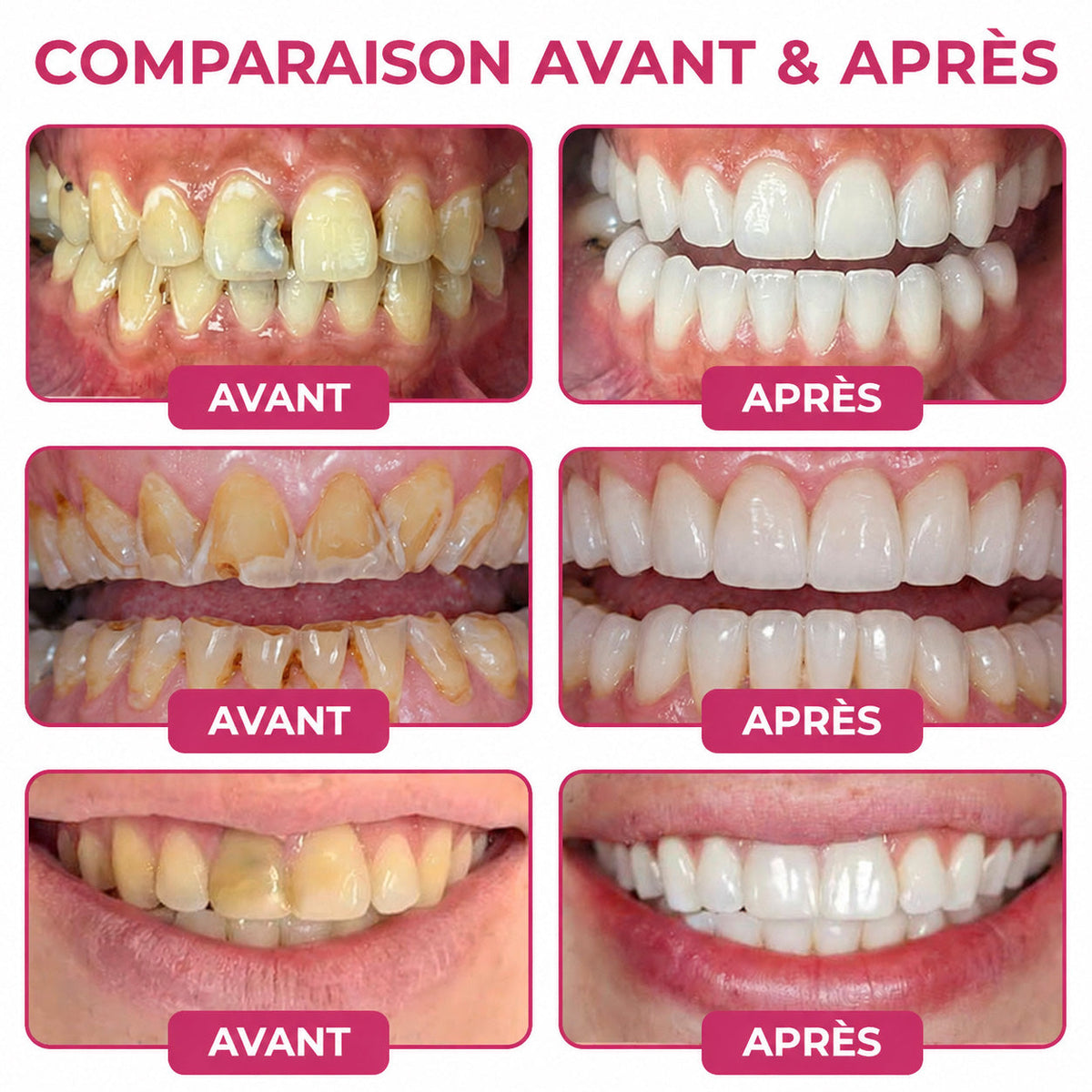 HEATWOLF® DenPerm – Gel naturel d’émail dentaire pour le traitement des caries (Copie)