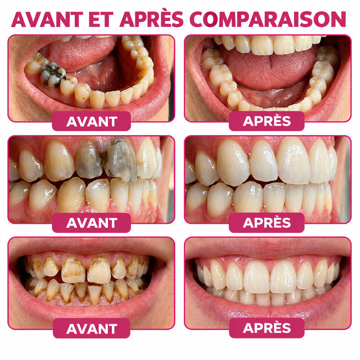 HEATWOLF® DenPerm – Gel naturel d’émail dentaire pour le traitement des caries (Copie)